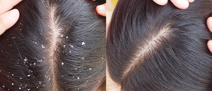 Henna Powder for Hair Dandruff Treatment: How Pankhudi Henna Powder Can Help